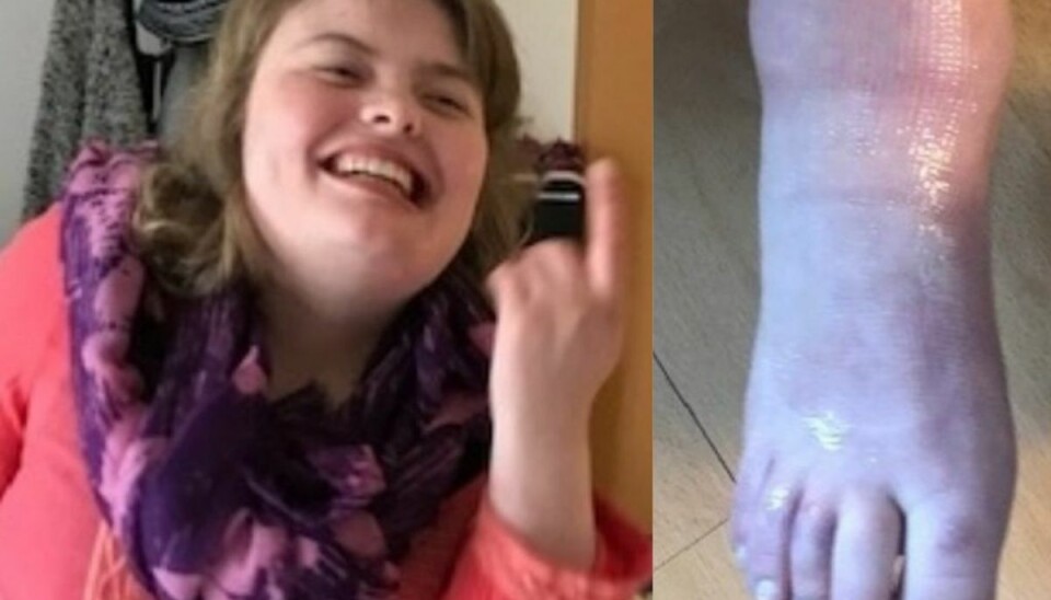 Nadia gik rundt med brækket ben i en måned