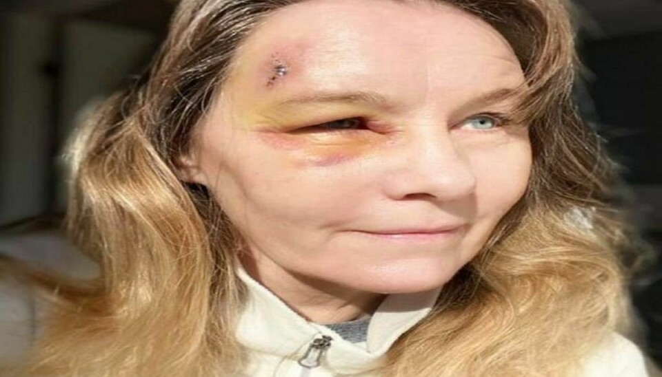 Charlotte Britt Nielsen blev ramt af så kraftigt et svimmelanfald, at hun faldt om og slog sit hoved slemt. Privatfoto