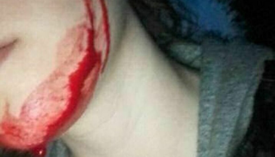 Sådan så 17-årige Emilia ud umiddelbart efter mødet med fire overfaldsmænd. Den ene snittede hende i ansigtet med en skarp genstand. Foto: Privat/Facebook. Anvendt med tilladelse.