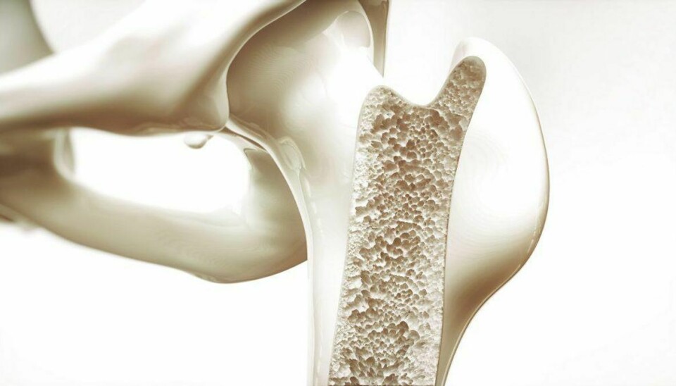 Osteoporose, også kaldet knogleskørhed, er en tilstand, hvor knoglemassen og -styrken er reduceret så meget, at man kan brække en knogle selv ved beskedne belastninger. Det skønnes, at 300.000 danskere lider af knogleskørhed. Foto: Scanpix. GALLERI: SYV ANDRE FOLKESYGDOMME. LÆS OM DEM VED AT KLIKKE VIDERE.