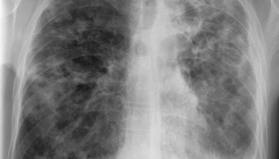Røntgenbillede af patient med fremskreden lungetuberkulose. Mange tuberkulosepatienter opdages først sent i forløbet, og det giver risiko for død og for alvorlige skader på lungerne. Foto: Forfatterne.