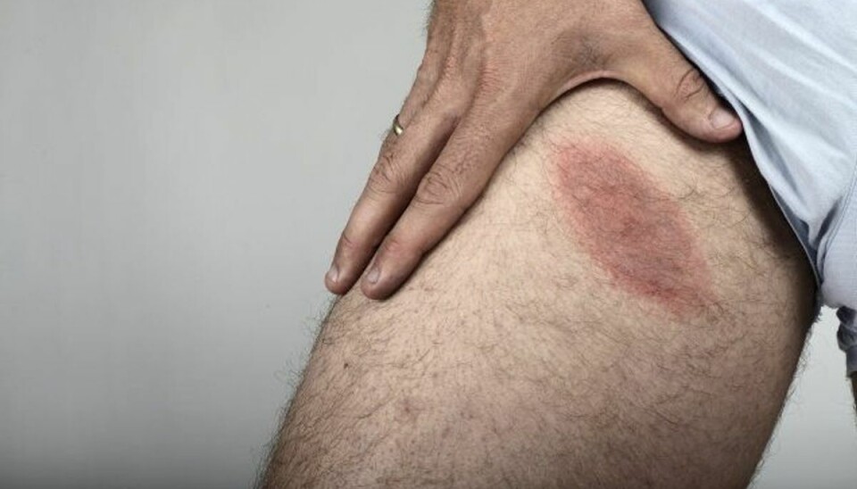 Forskere vil kortlægge flåtsygdomme Billede af skader ni dage efter bid fra skovflåt. Der kom først udslæt efter syv dage, så mærket er kun to dage gammelt. Foto: Jeppe Bøje Nielsen/arkiv/Scanpix