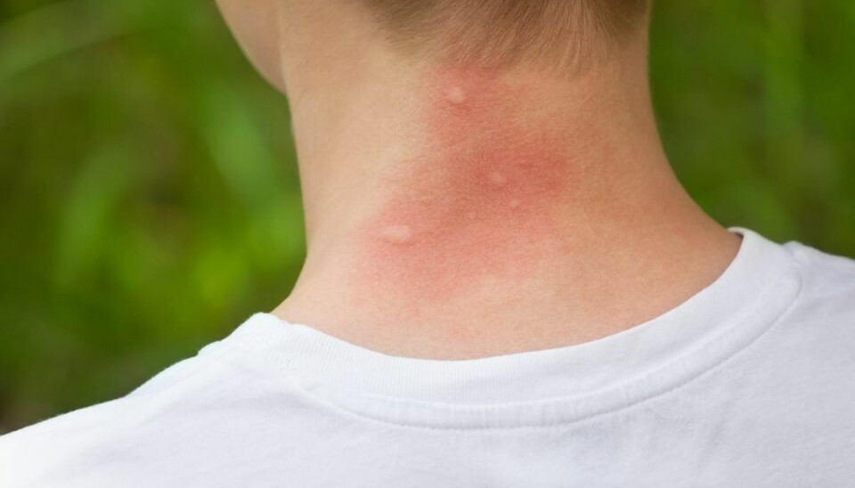 Du kender myg og hvepse, men disse insekter stikker og bider også i sommervarmen