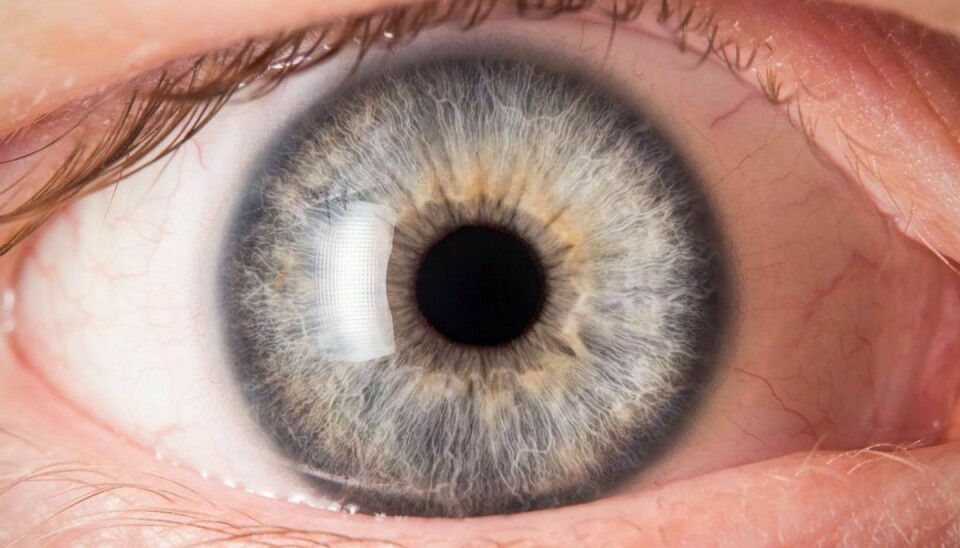 Kræft i øjnene er en relativt sjælden kræftform, men rammer alligevel mere end 50 danskere årligt. (Foto: Shutterstock)