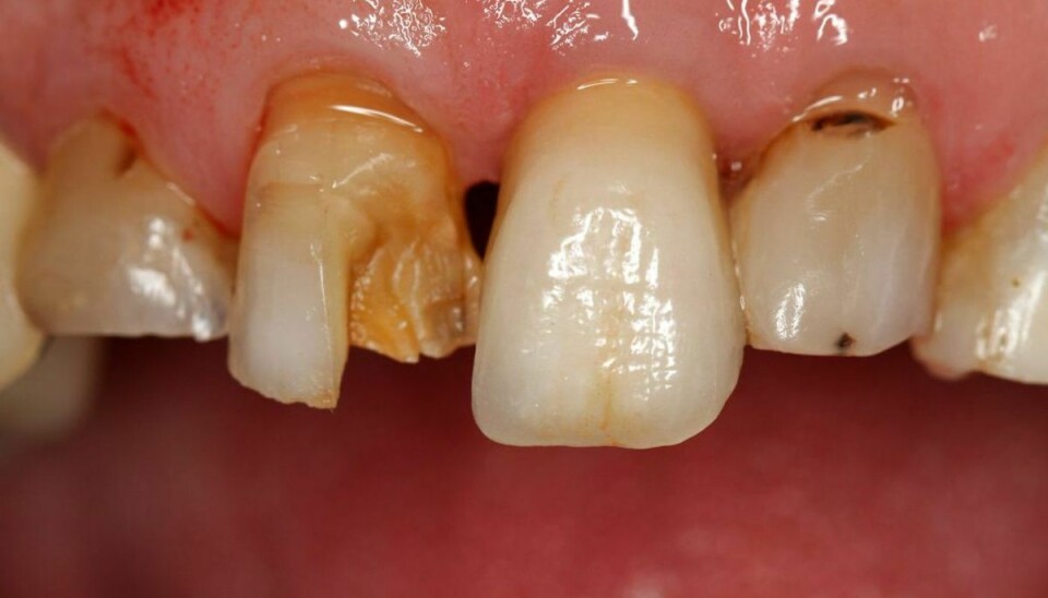 Hvor længe skal man børste tænder for at undgå tænder som disse? To minutter. Hvordan? Fotos: Scanpix / Kilde: Tandlægeforeningen KLIK for at blive klogere.