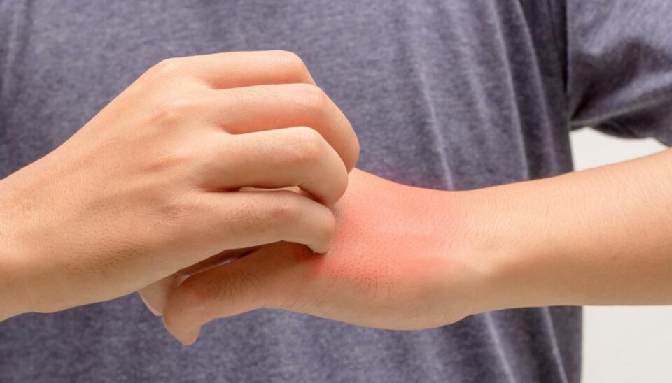Mangel på vitamin a er en alvorlig lidelse, som blandt andet kan medføre tør hud. KLIK VIDERE OG SE, HVILKE FØDEVARER DET ER EN GOD IDE AT SPISE, HVIS DU MANGLER A VITAMIN. Arkivfoto. Mangel på vitamin a er en alvorlig lidelse, som blandt andet kan medføre tør hud. KLIK VIDERE OG SE, HVILKE FØDEVARER DET ER EN GOD IDE AT SPISE, HVIS DU MANGLER A VITAMIN. Arkivfoto.