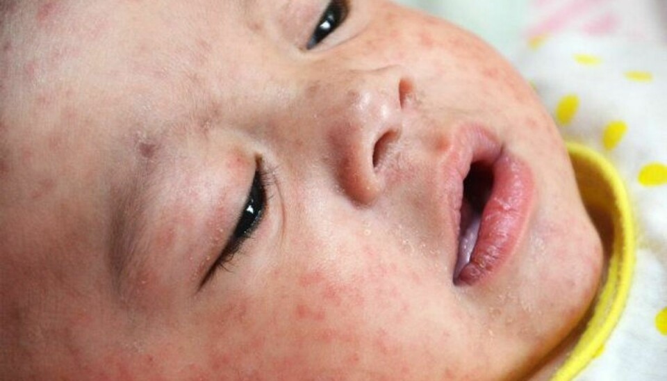 Sundhedsstyrelsen anbefaler, at børn vaccineres med MFR-vaccinen, som beskytter mod mæslinger, når de er 15 måneder og fire år. (Arkivfoto) Foto: Jim Goodson/Cdc/Science Photo Li/Scanpix