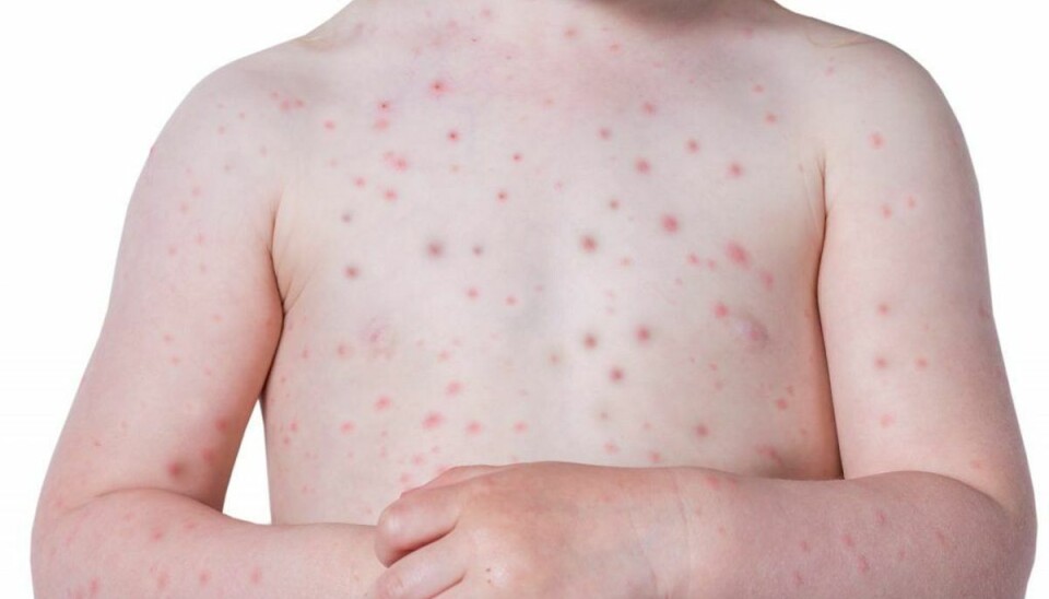 Vaccine-hadende politiker syg med skoldkopper Vaccination mod skoldkopper er i Danmark ikke en del af børnevaccinationsprogrammet. Det er den i Italien. (Foto: Shutterstock)