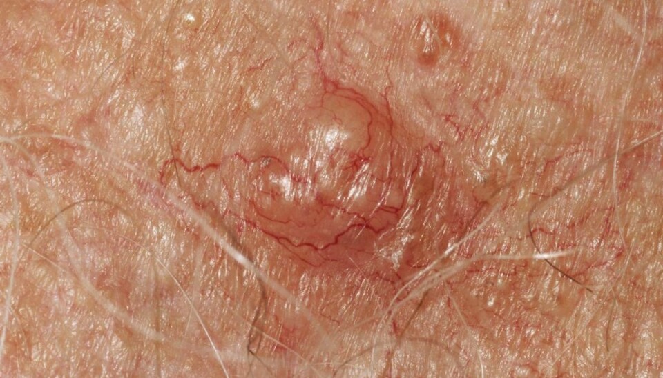 Fotos af hudkræft: Sådan kan det se ud, når man er ramt af basalcellekræft- carcinoma basocellulare- der er den almindeligste form for hudkræft. Foto: Scanpix.