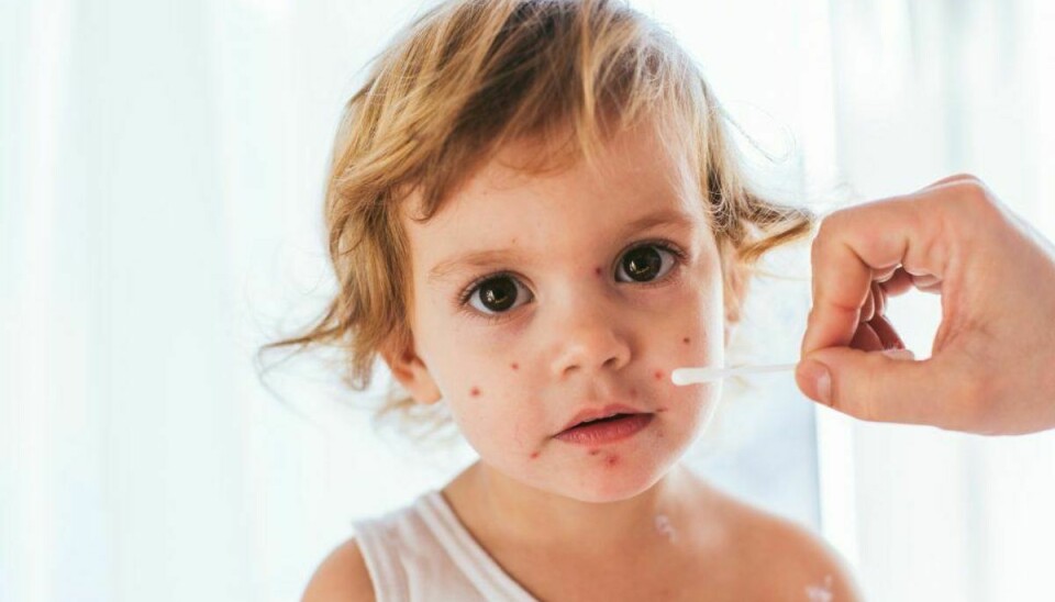 Har dit barn udslæt og feber? Så er der en god chance for, at det er den meget smitsomme børnesygdom skoldkopper. Klik igennem galleriet for at se billeder af skoldkopper for at være helt sikker. (Foto: Shutterstock)