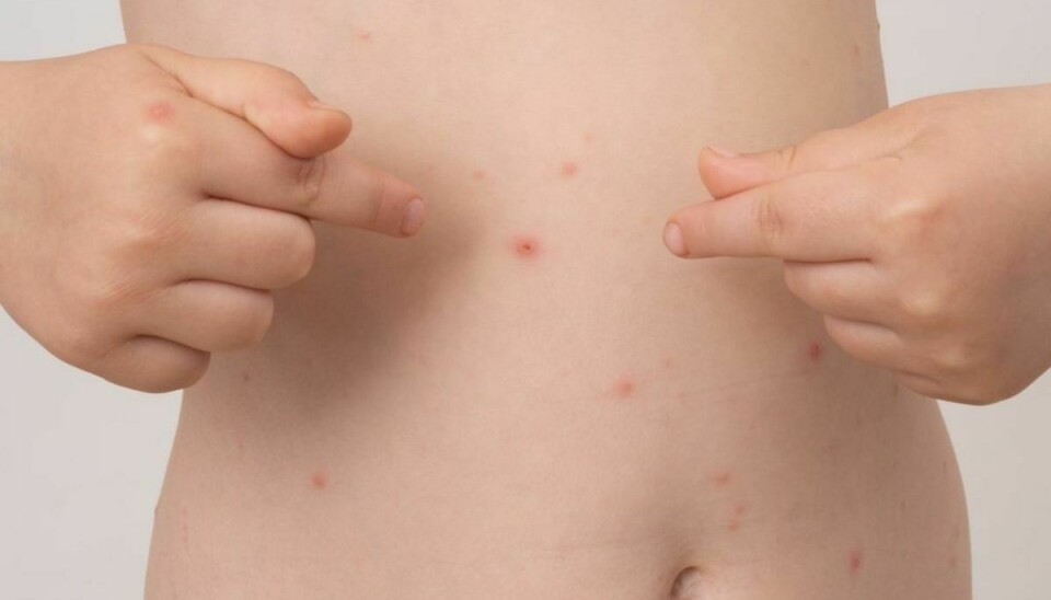 Børn kan få mange former for udslæt på huden, derfor kan billeder af skoldkopper hjælpe med at identificere om det er det dit barn har fået.
