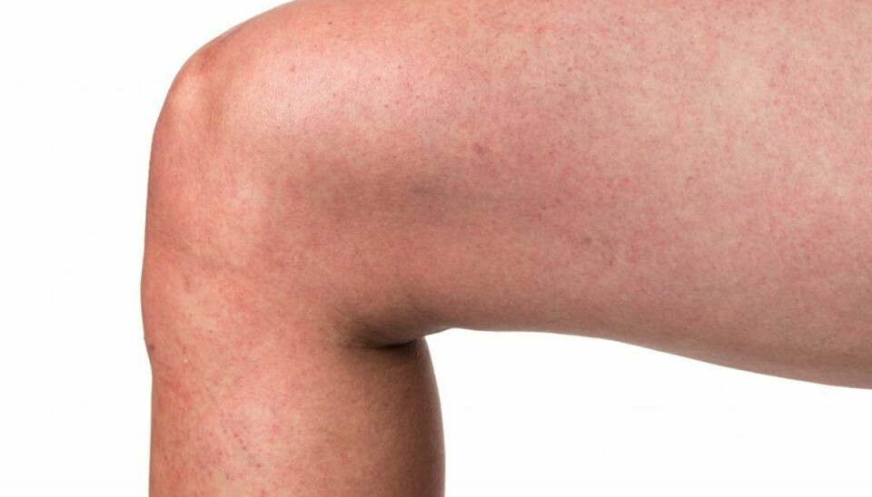 Kan virke harmløs: Men en bestemt gruppe skal være meget opmærksom på denne sygdom Lussingesyge kan i værste fald være særdeles farligt for gravide. Arkivfoto.