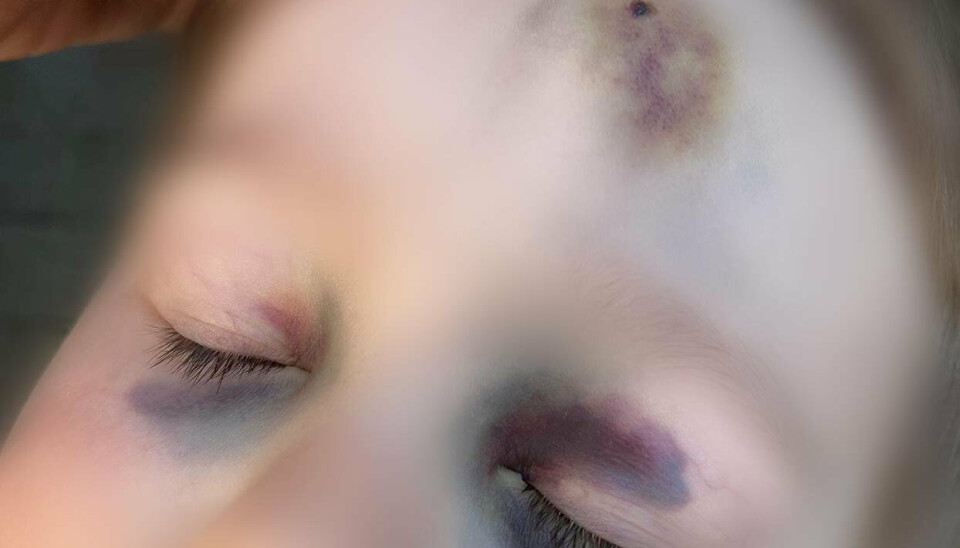 Sådan så Nana Sophia Axelsens tre-årige dreng ud efter et overfald i drengens børnehave.