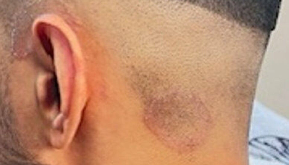 Symptomerne på Tinea capitis er rødme, skæl og knækkede hårstrå på et mindre og velafgrænset område. Infektionen kan også give bylder.