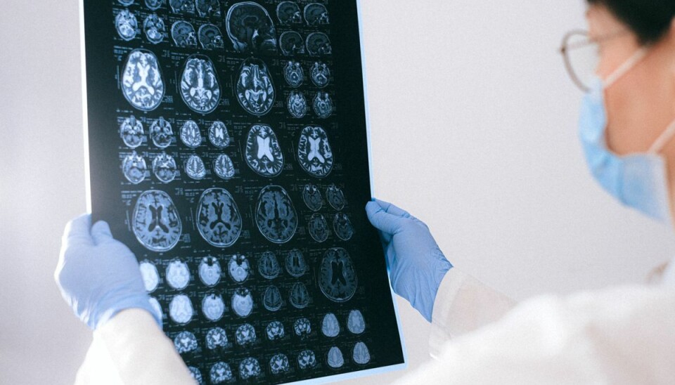 Der er lovende nyt i forskning af medicin mod Alzheimers, lyder det. Det amerikanske medicinselskab Eli Lilly har fundet ud af, at det sinker udviklingen af sygdommen. Der er lovende nyt i forskning af medicin mod Alzheimers, lyder det. Det amerikanske medicinselskab Eli Lilly har fundet ud af, at det sinker udviklingen af sygdommen.