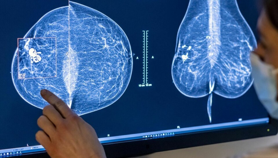 Indtil videre har knap 50 kvinder krævet erstatning, efter at de er blevet indkaldt for sent til screening for brystkræft. (Arkivfoto).
