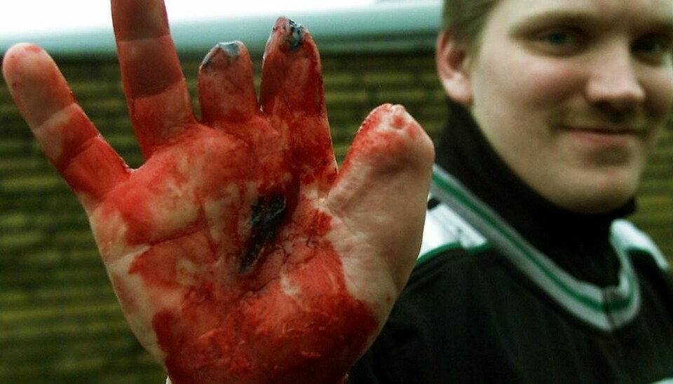 Jan Poulsen, fik sine fingre sprængt af 3 dage før nytåret 1998, da han brugte ulovligt fyrværkeri. M
