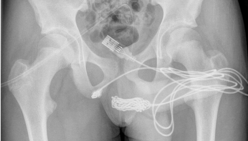 Røntgenbillede af kablet - og dele af kroppen.