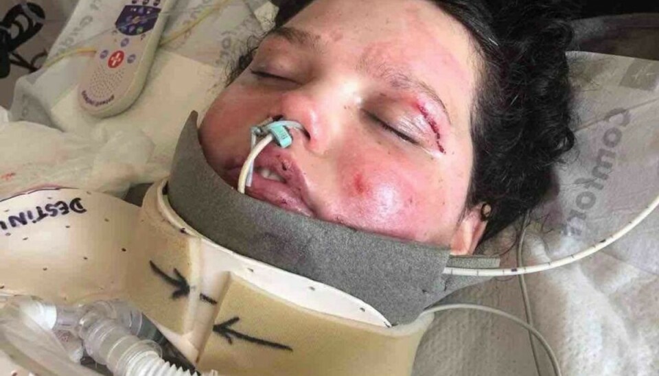 En TikTok-udfordring gik grueligt galt for 13-årige Destini Crane, som blev voldsomt forbrændt. Foto: Andrea Crane/GoFundMe En TikTok-udfordring gik grueligt galt for 13-årige Destini Crane, som blev voldsomt forbrændt. Foto: Andrea Crane/GoFundMe
