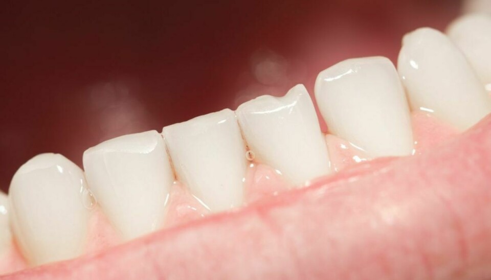 Hollandske og danske forskere har fundet ud af, at dine tandsten kan afsløre brug af narkotika. Genrefoto.